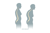 A Physical Therapy Guide to Hyperkyphosis (Humpback) - CityPT