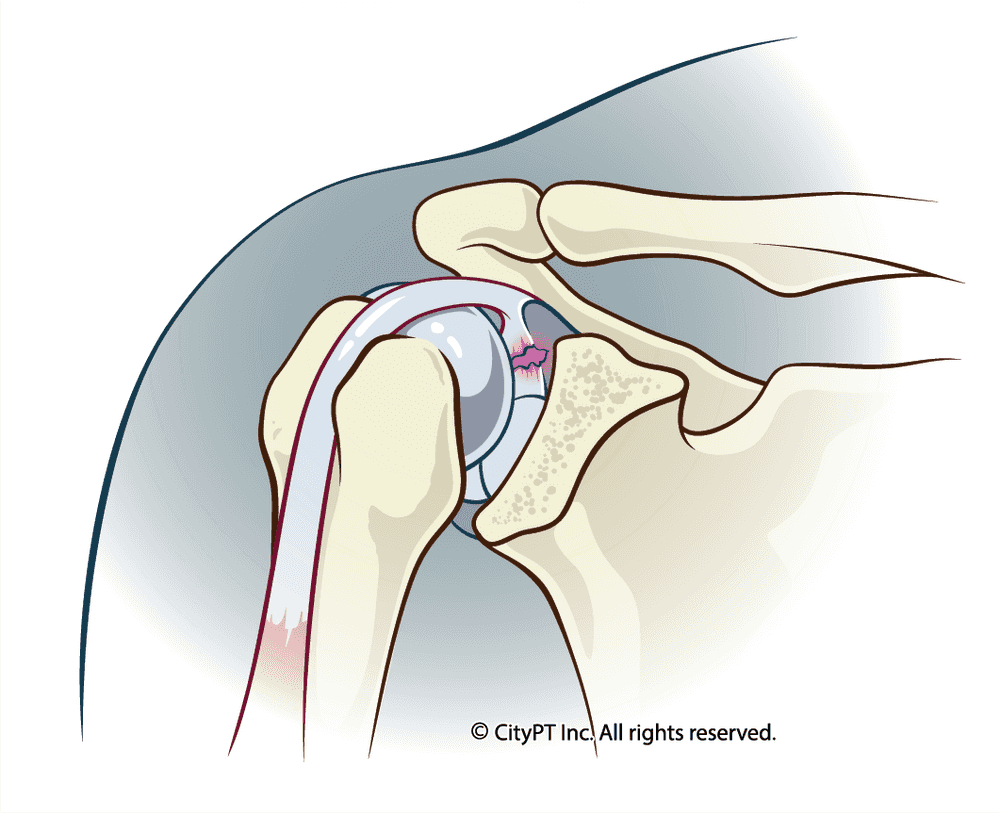 Anatomical illustration of a shoulder labrum irritation