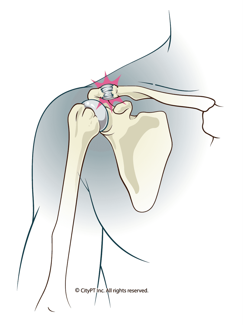 Anatomical illustration of an AC Joint Injury