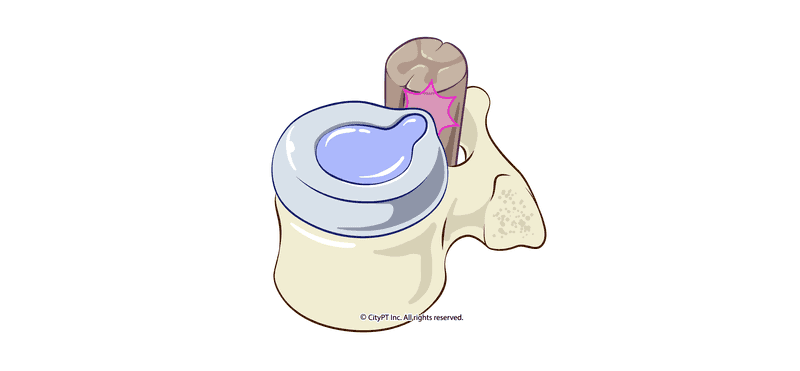 Disc Herniation - Physiopedia